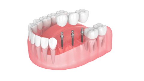 Dental Bridge in Missoula, MT | Affordable Mini Implants