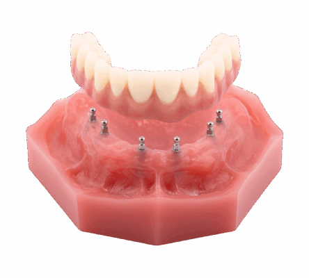 Full-Mouth Dental Implants in Missoula, MT | Affordable Implants