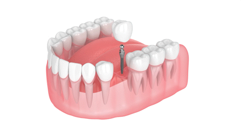 Same-Day Dental Implants in Missoula, MT | Affordable Tooth Replacements With Mini Implants