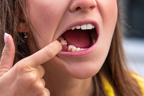 Tooth Extractions in Missoula, MT | Keeping Your Smile Healthy 😁