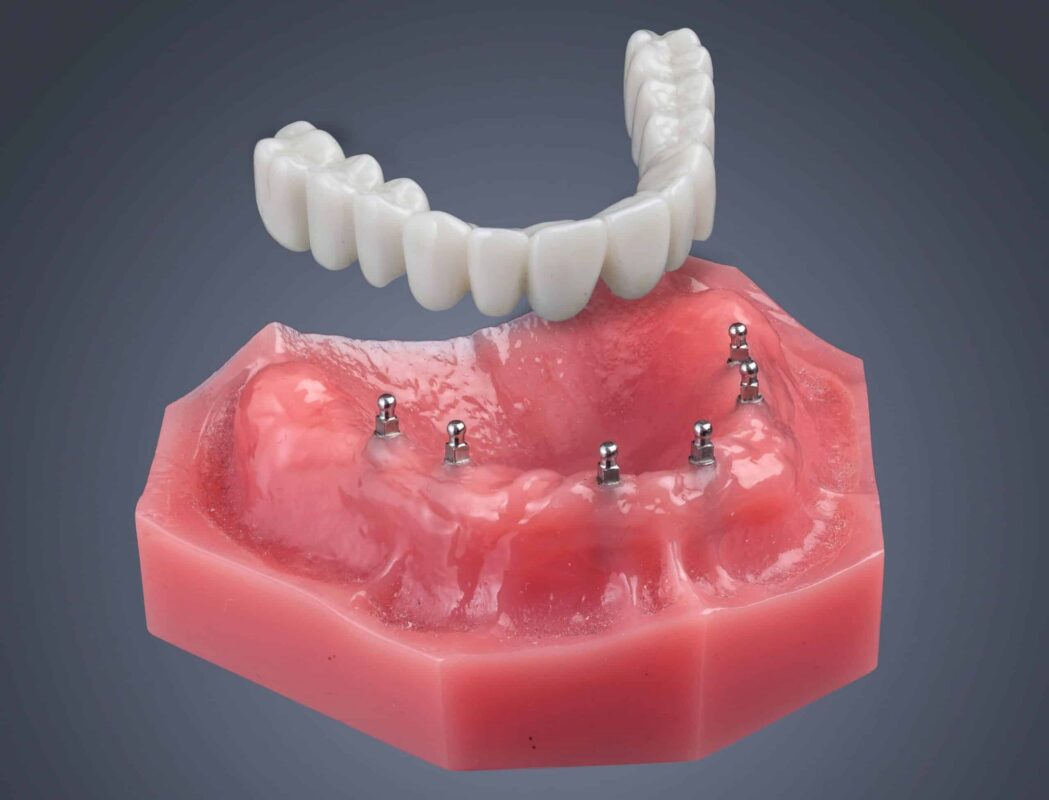 Roundhouse Bridge in Missoula, MT | Affordable Implant Dentures