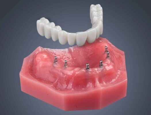 Roundhouse Bridge in Missoula, MT | Affordable Implant Dentures